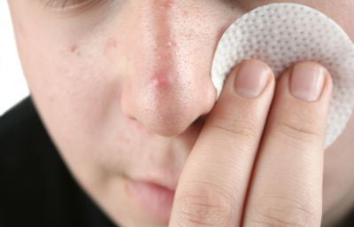 3 Things That You Didn’t Know Could Cause Pimples
