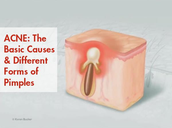 ACNE: The Basic Causes and Different Forms of Pimples