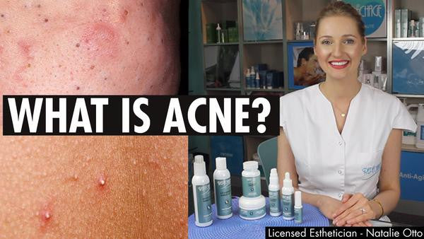 What is Acne?